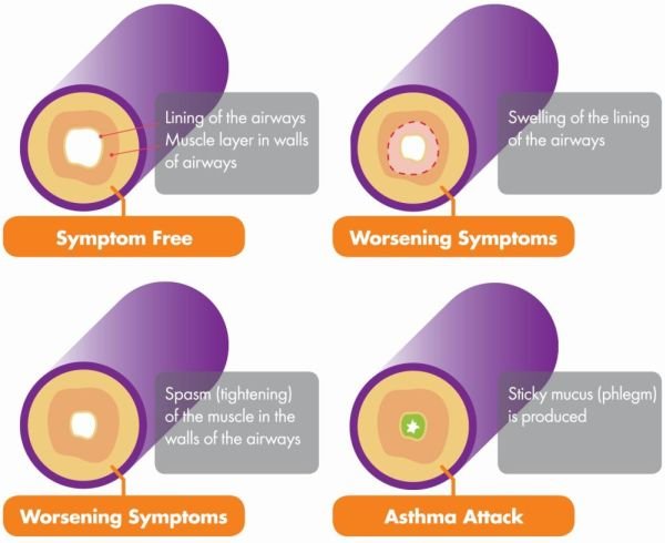 What happens to the airways in asthma